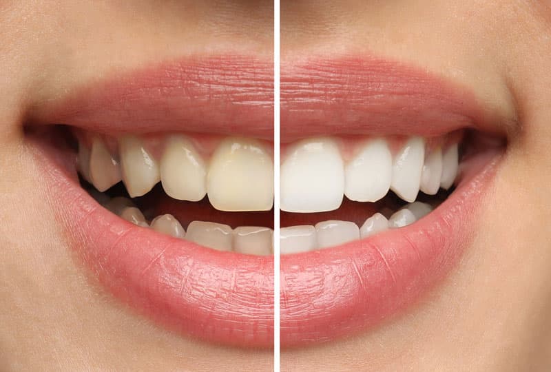 Blanqueamiento dental en a coruña